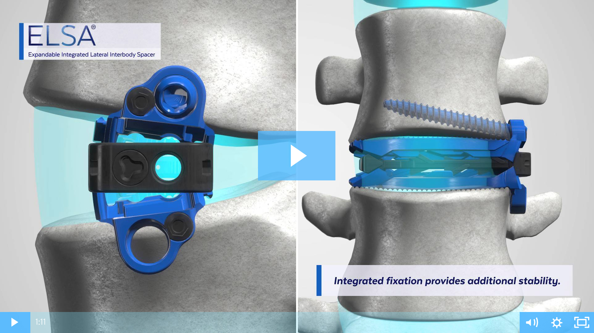 ELSA® Expandable Integrated LLIF Spacer