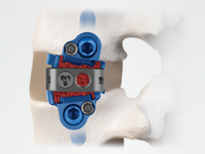 ELSA™ Product Page - Expandable Technology