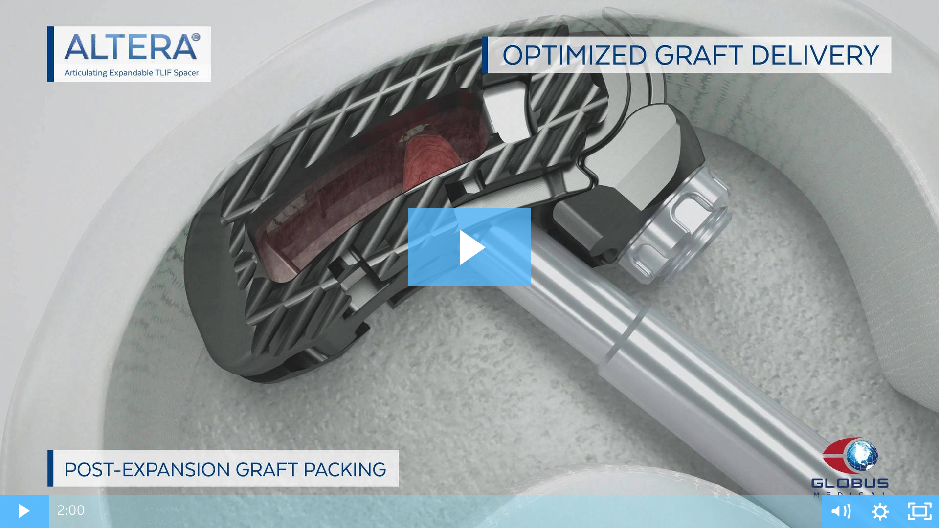 ALTERA™ Articulating Expandable TLIF Spacer