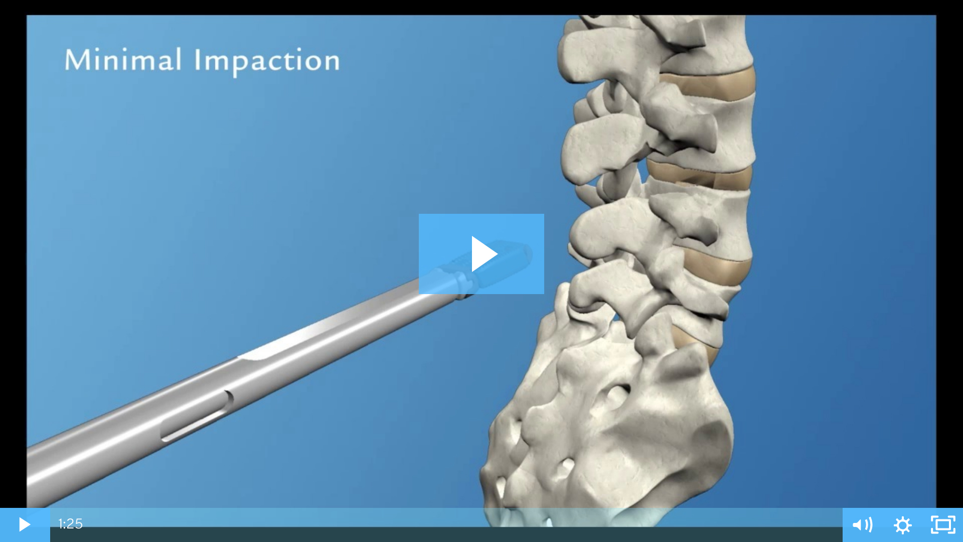 RISE™ Expandable TLIF Spacer