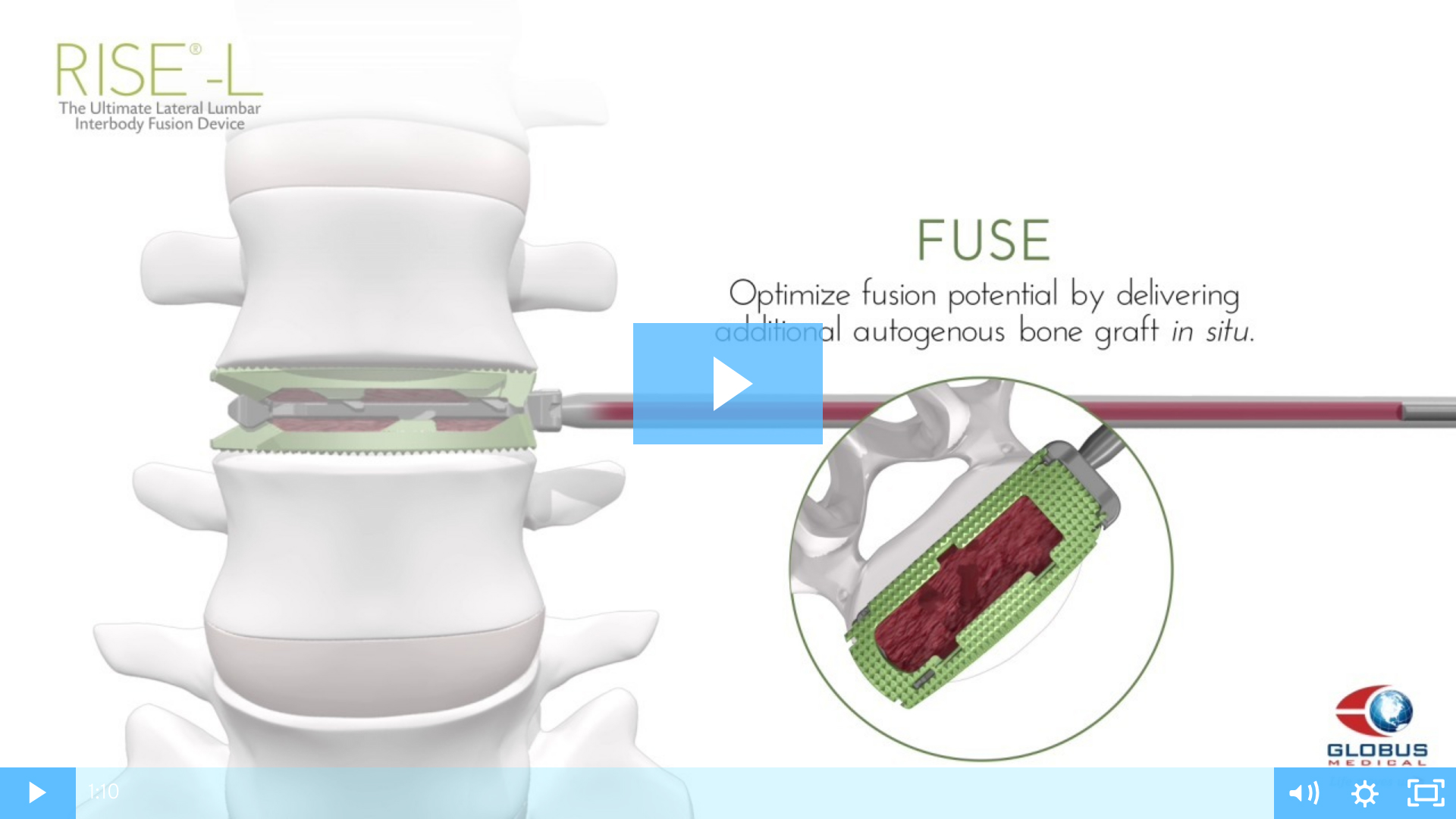 RISE™-L Expandable LLIF Spacer