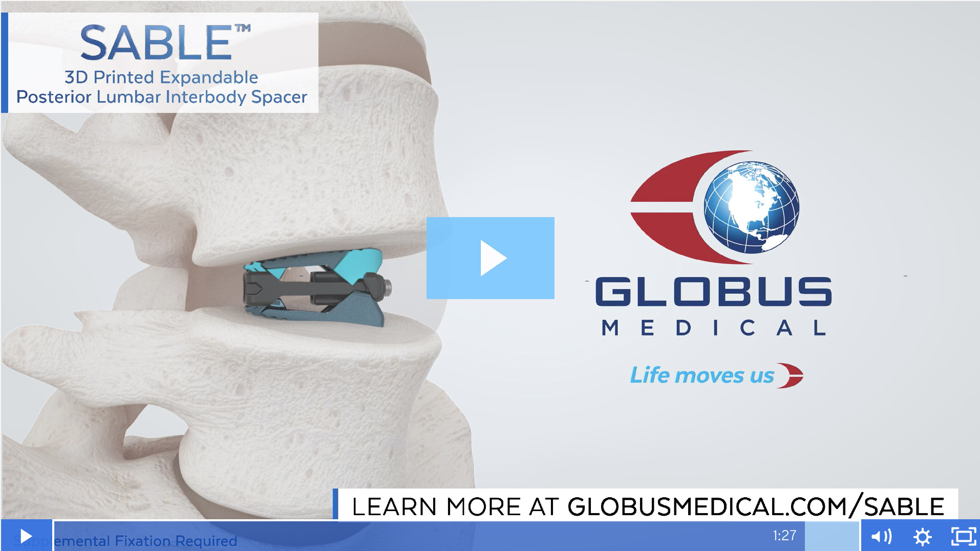 SABLE™ 3D Printed Expandable Posterior Lumbar Interbody Spacer