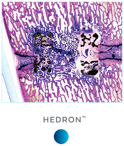 hedron