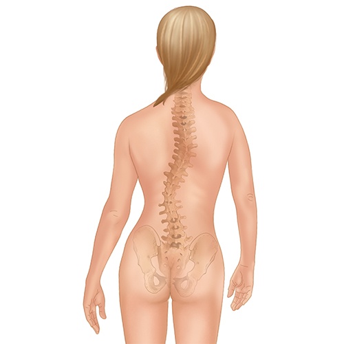 Adolescent scoliosis of the adult