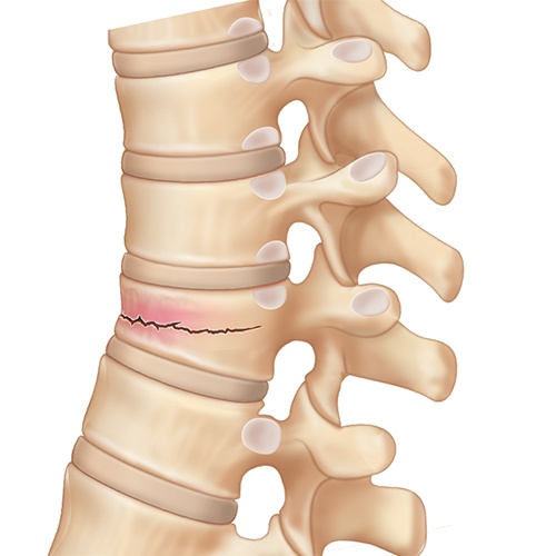 Compression Fracture