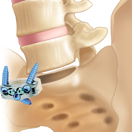 integrated lumbar plate and spacer with screws