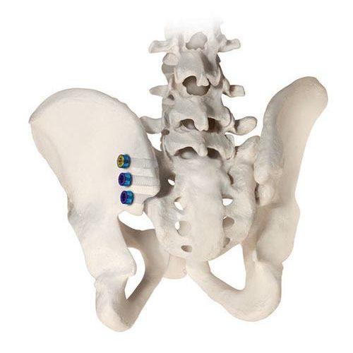 SI-LOK Sacroiliac Joint fixation system