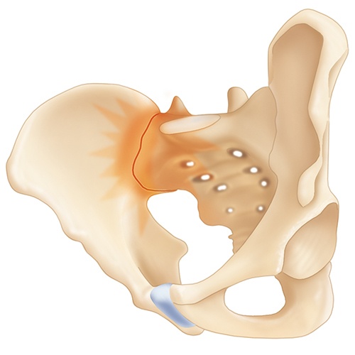 Sacroiliac Joint Dysfunction