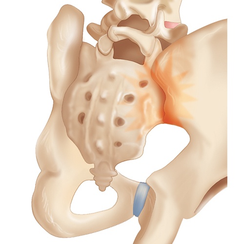Sacroiliac joint causes of pain