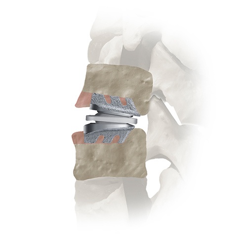 Secure-C Anterior Cervical Extension Bending