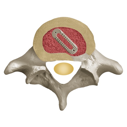 Posterior Spine Spacer