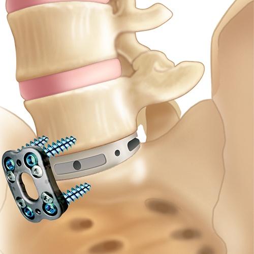 lumbar plate with spacer and screws