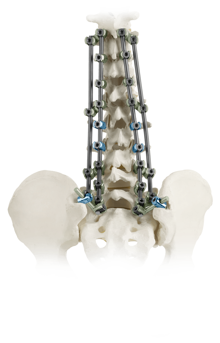 CREO® AMP QUAD™ for Adult Deformity