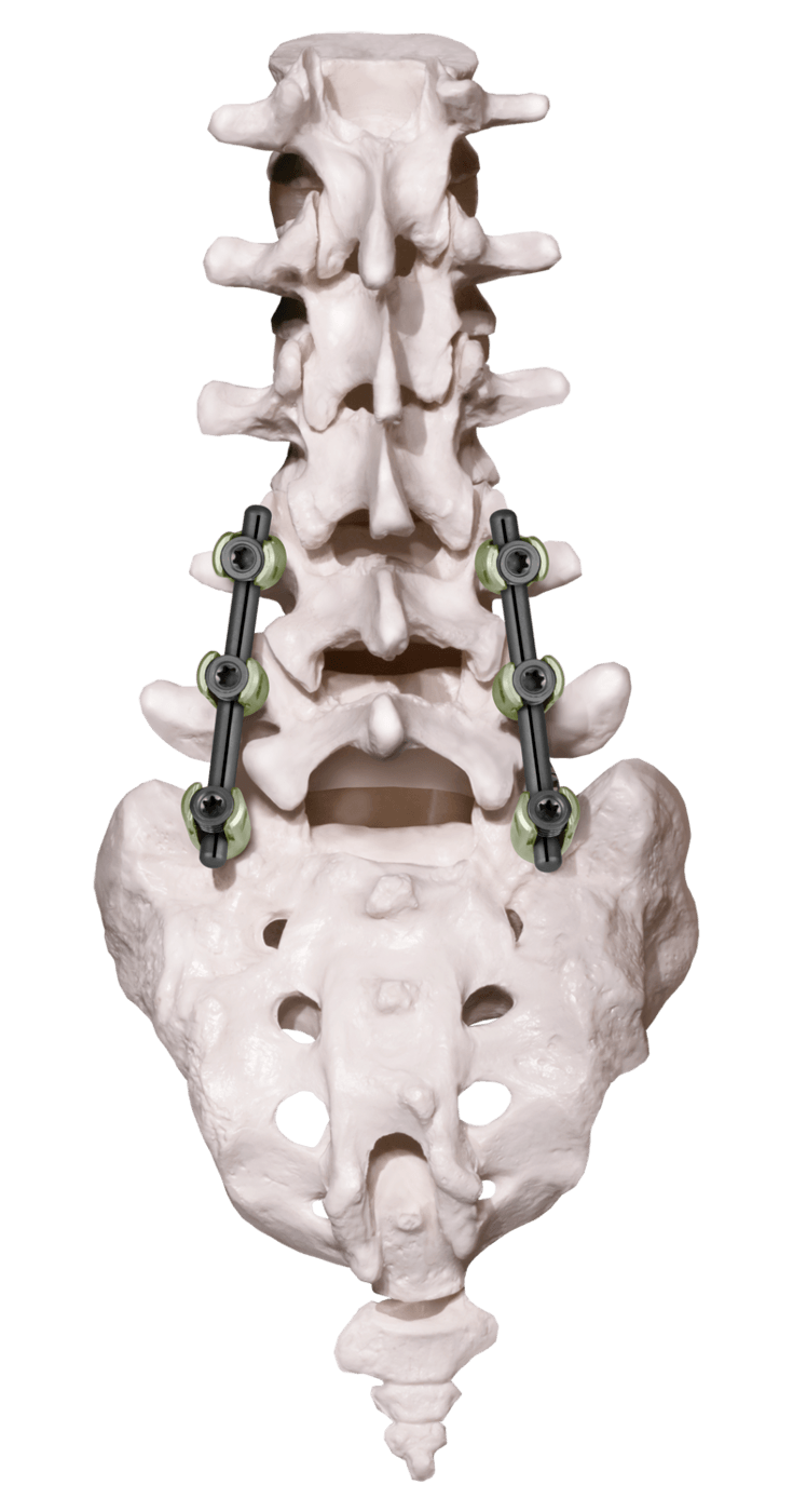 CREO® Threaded Stabilization System