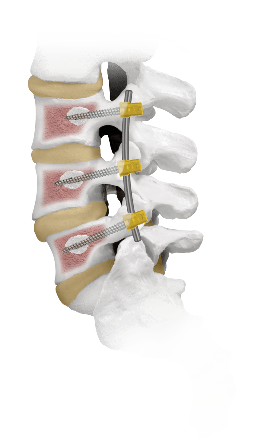 CREO® Fenestrated Lumbar Bone Model