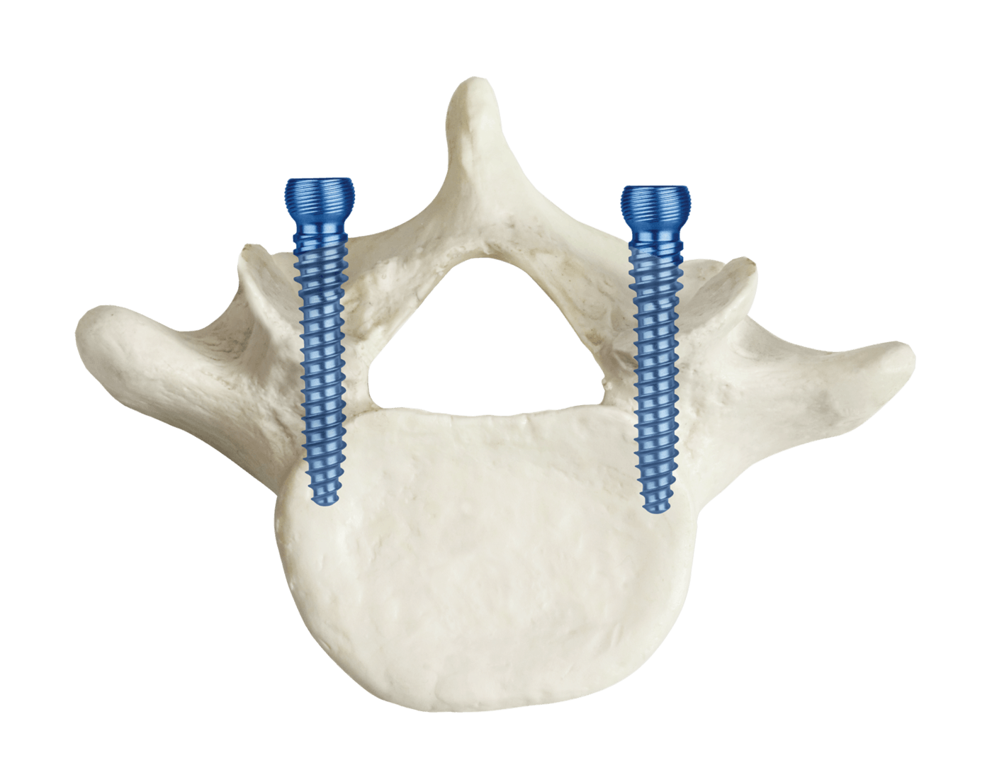 CREO® MCS Sagittal Trajectory