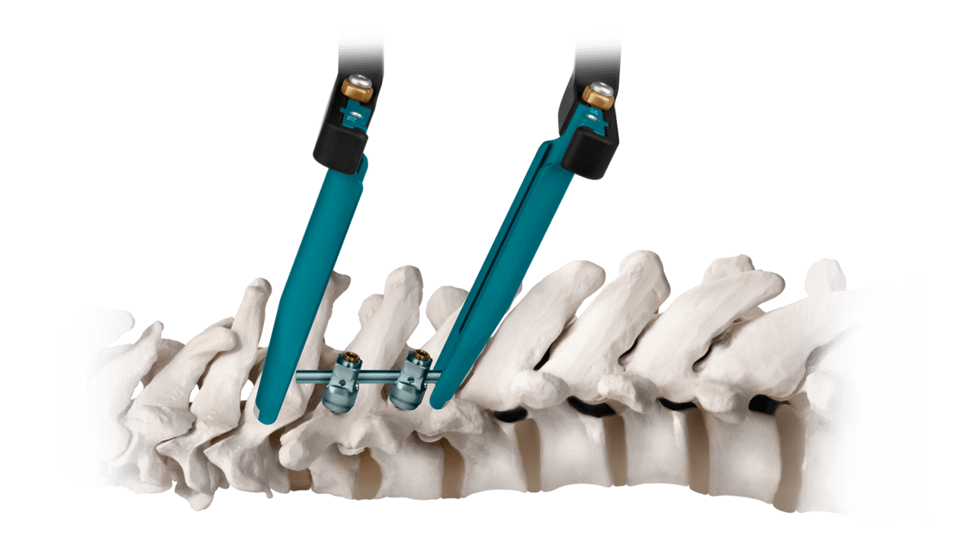 CAPITOL® screws Minimally Invasive Cervico Thoracic