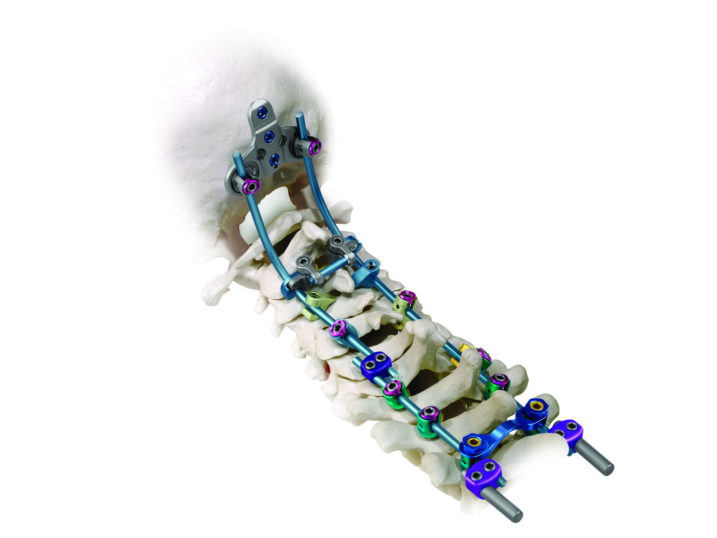 Fully Constructed ELLIPSE® Posterior Occipito-Cervico-Thoracic Stabilization System