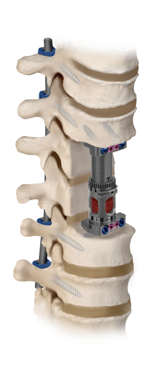 FORTIFY® I Integrated Expandable Corpectomy Spacer Final Construct, Oblique View