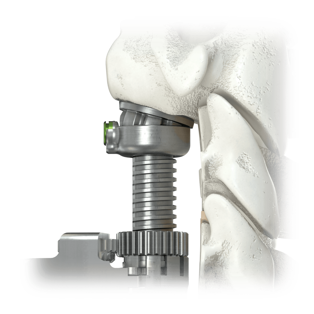 Precise Fit for FORTIFY VA™ Implant