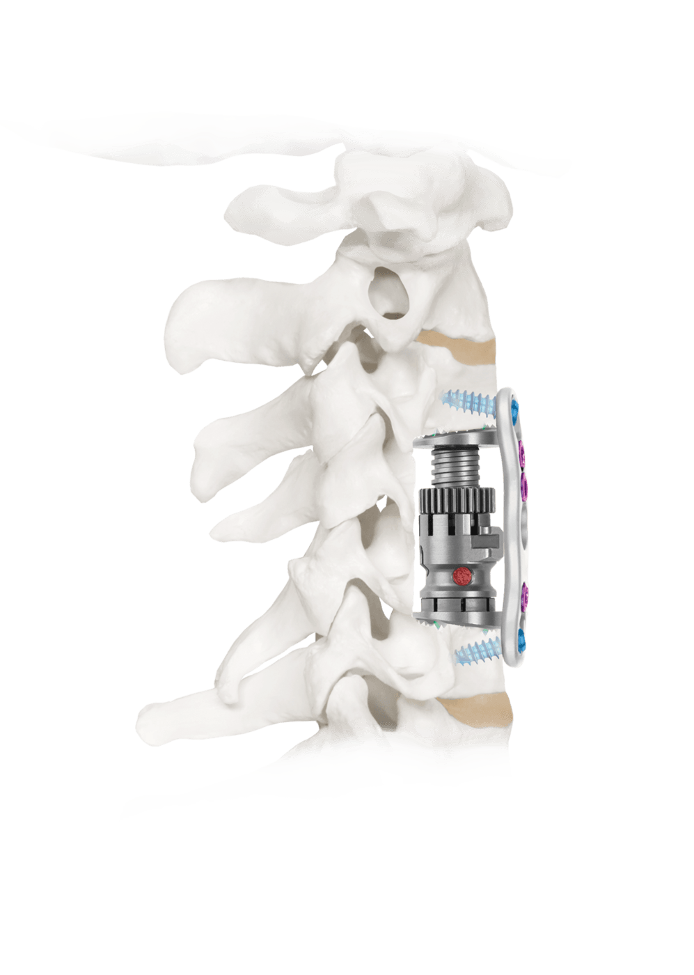 FORTIFY® with Expansion, Lateral View