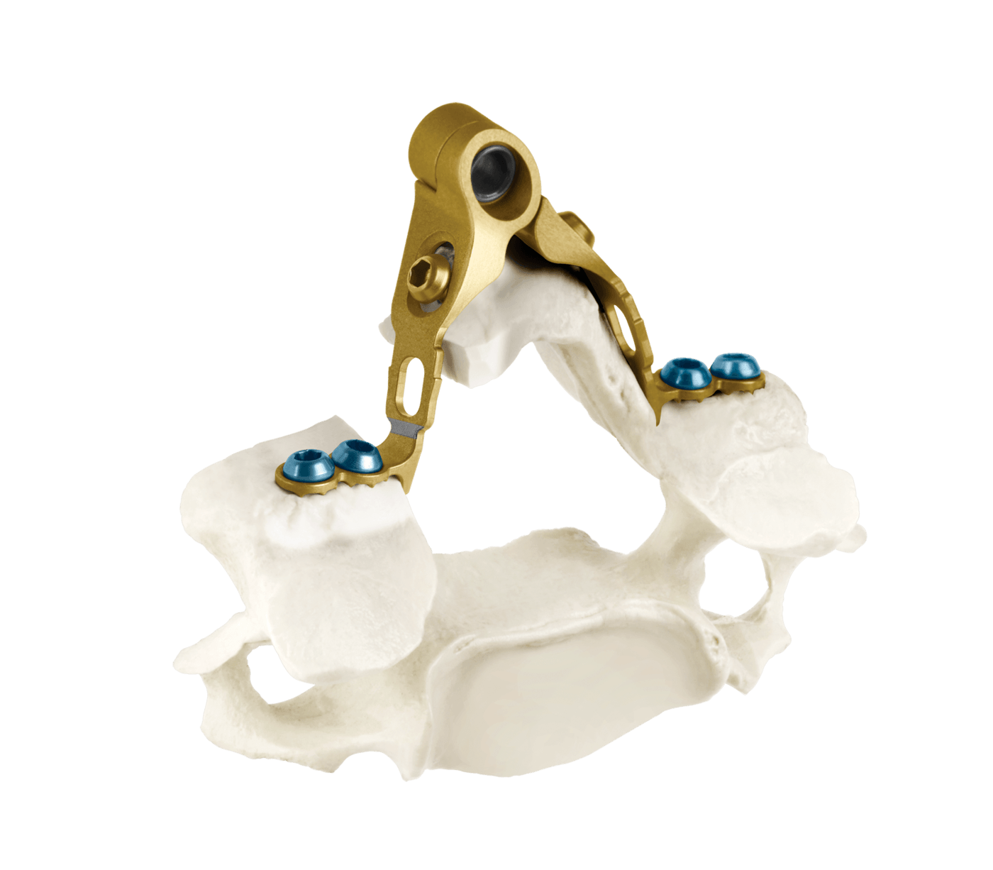 HAVEN® Dual Plate Laminoplasty System, Oblique Axial View