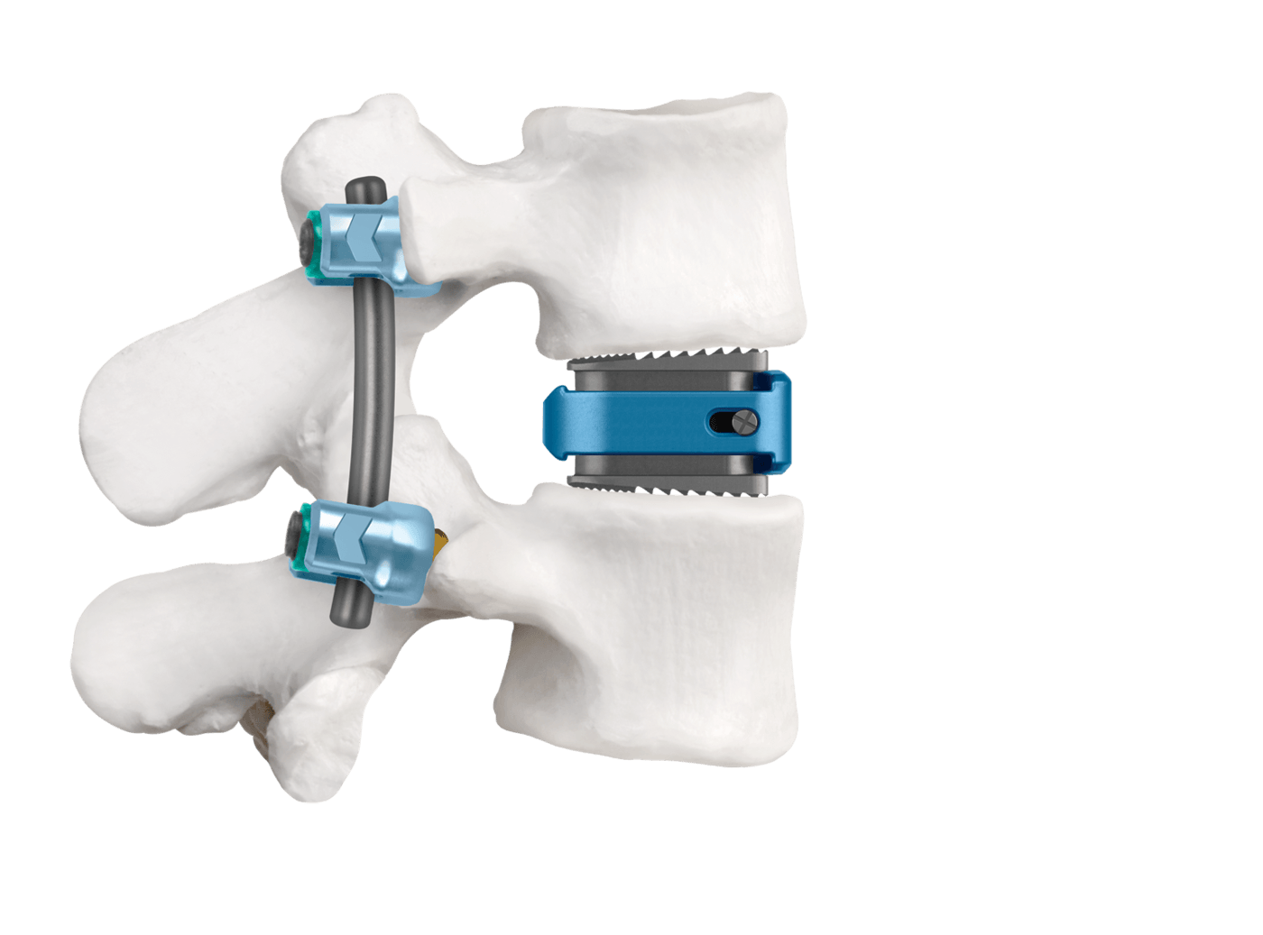 MAGNIFY® Expandable ALIF Spacer Final Construct, Expanded Insertion Height