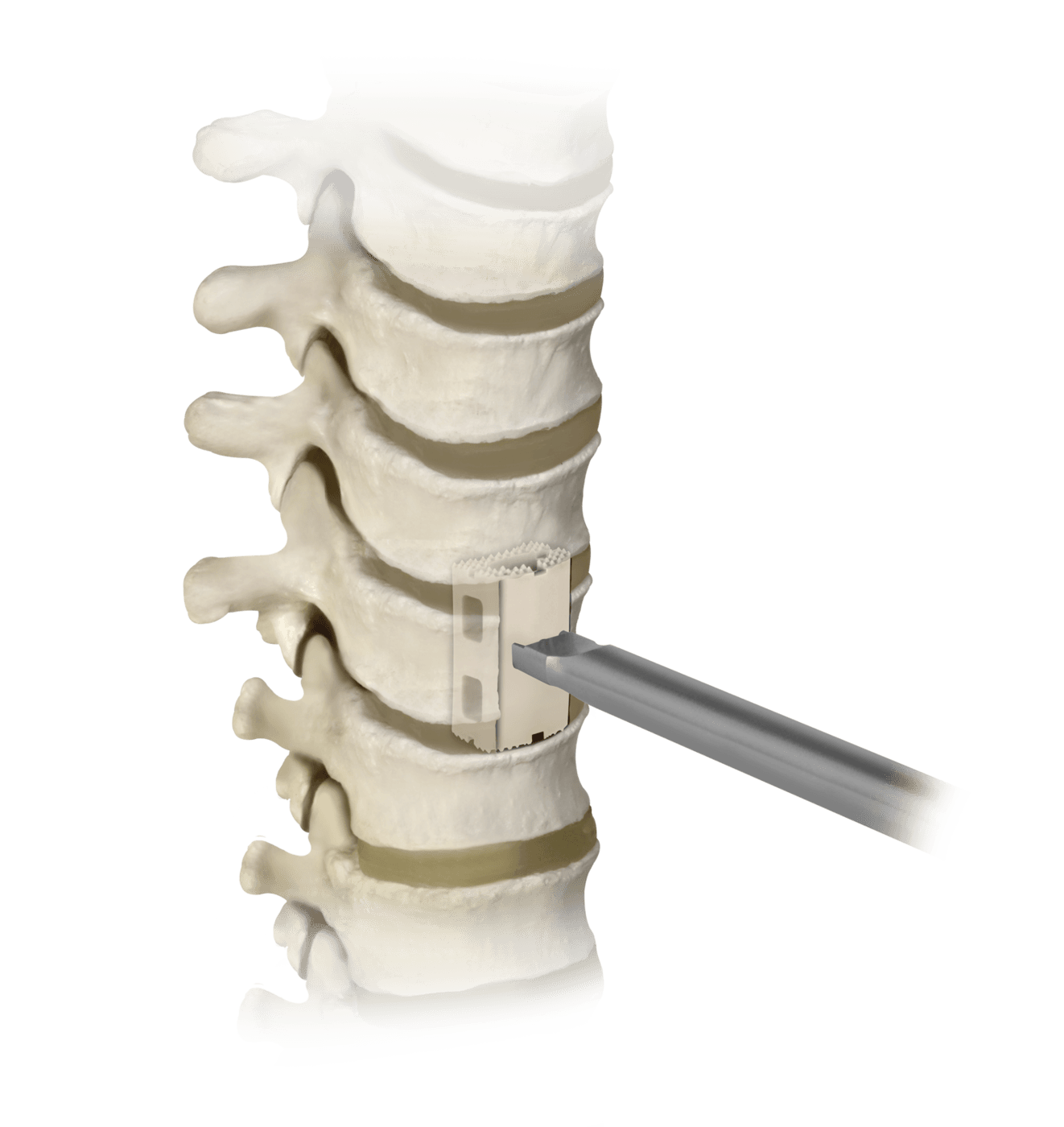 Fully Constructed NIKO® Corpectomy Spacer