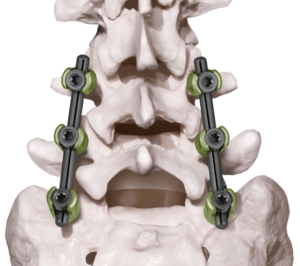 PROTEX® Posterior Stabilization System