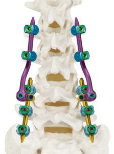 REVERE® Corrective Osteotomy Final Construct Posterior View