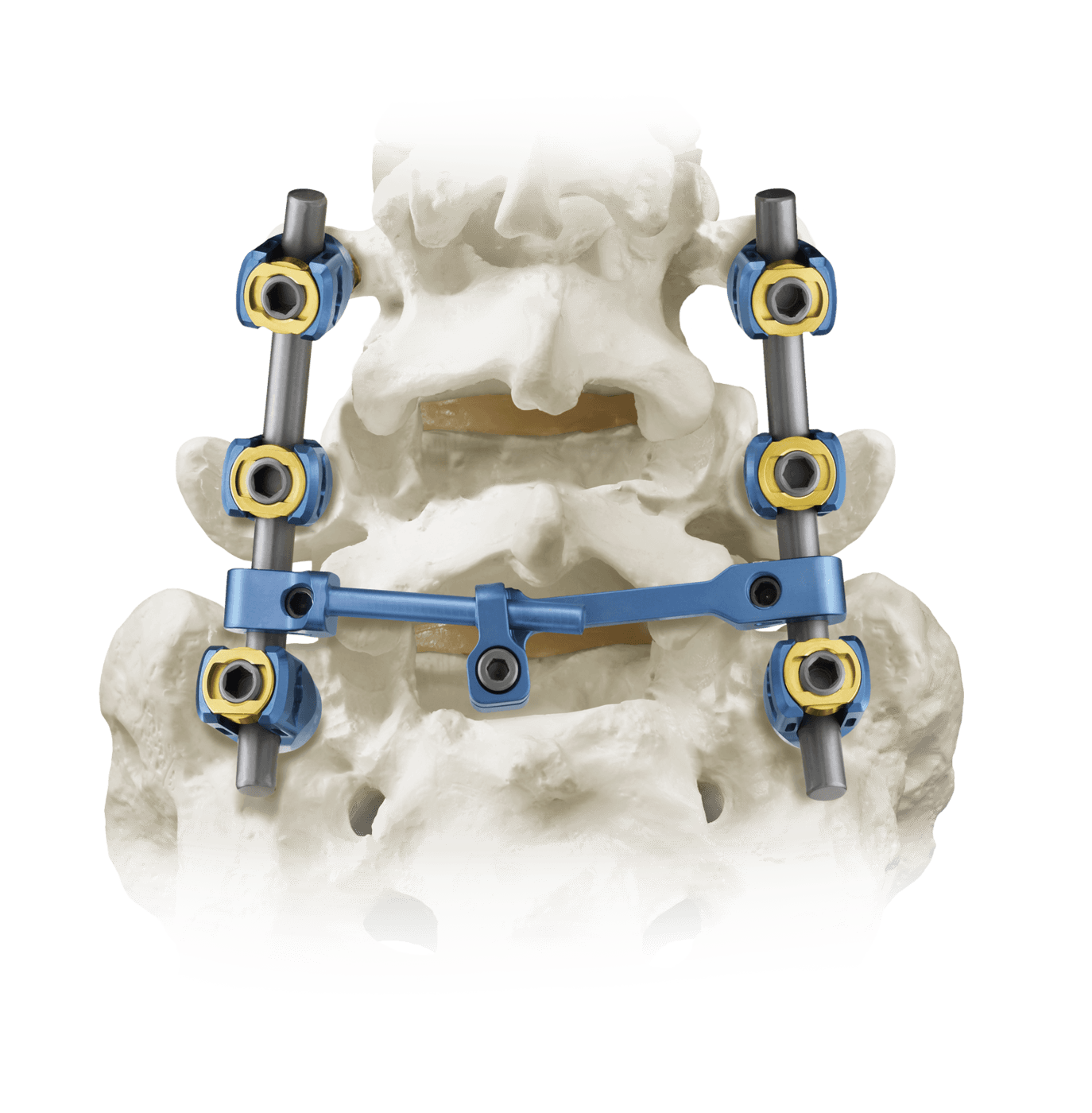 Fully Constructed REVERE® Thoracolumbar Stabilization System