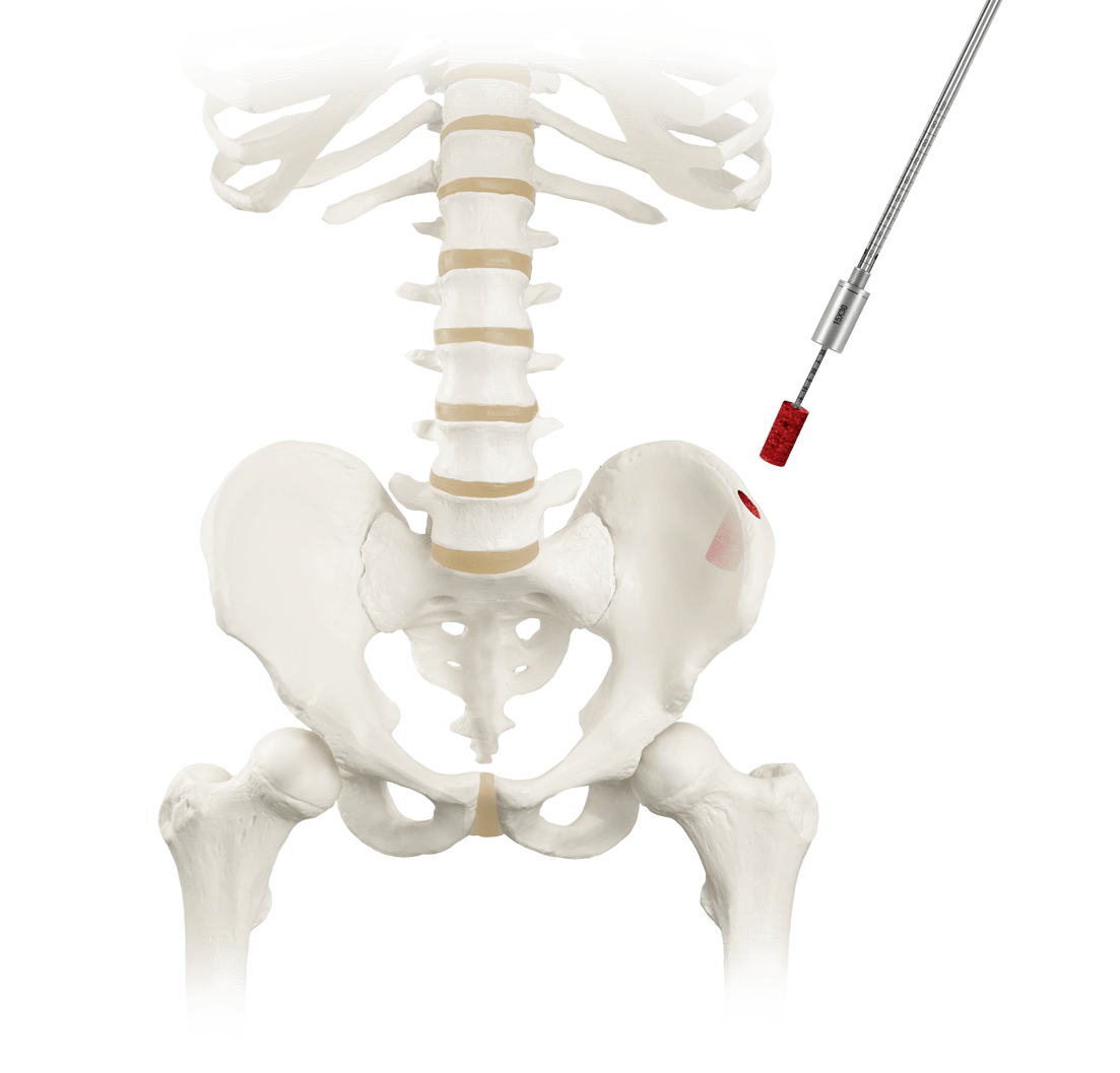 RETRIEVE® Bone Graft Harvest Removal