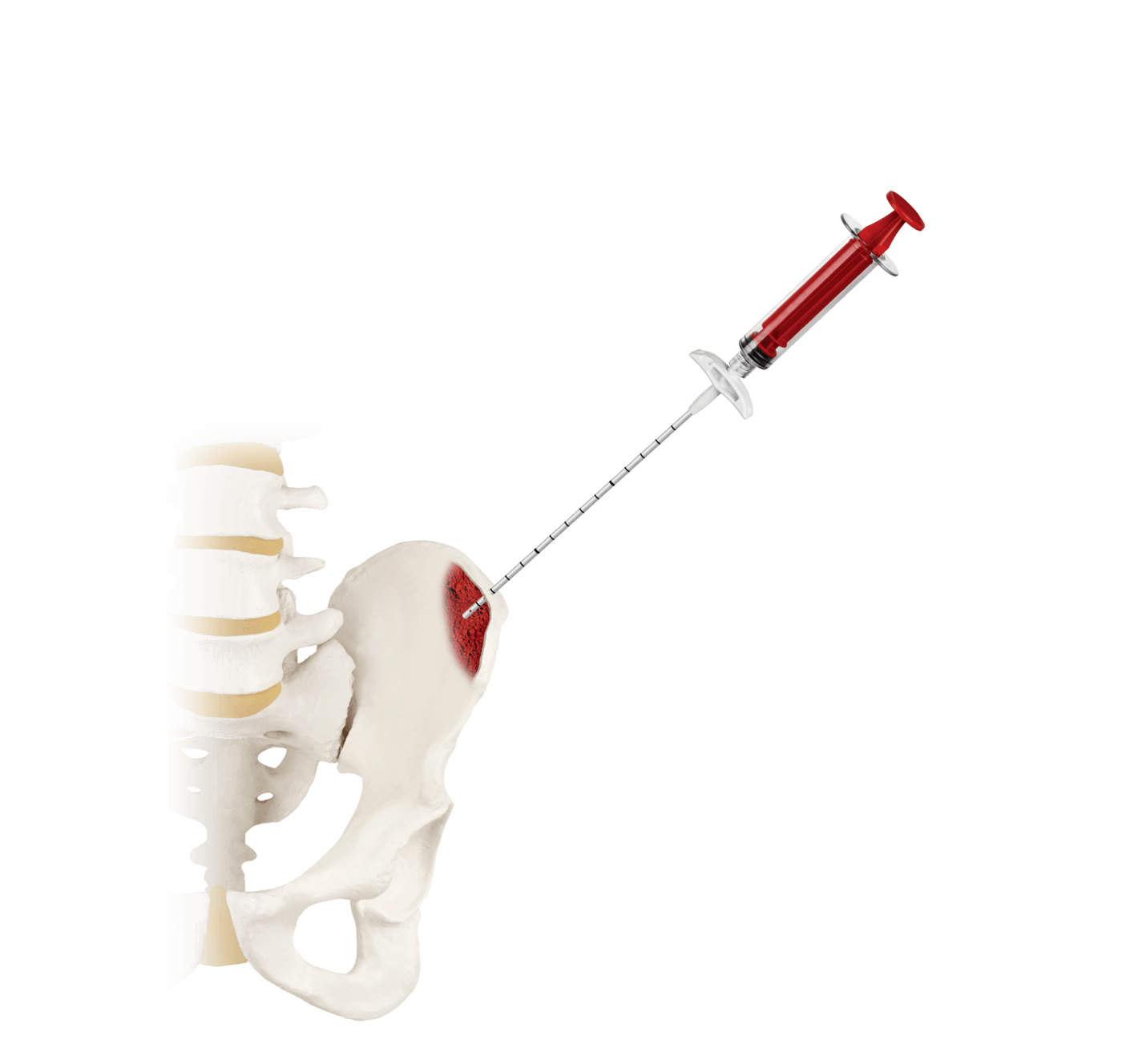 RETRIEVE® Bone Marrow Aspirate (BMA) Kit, Syringe Attached to Patient