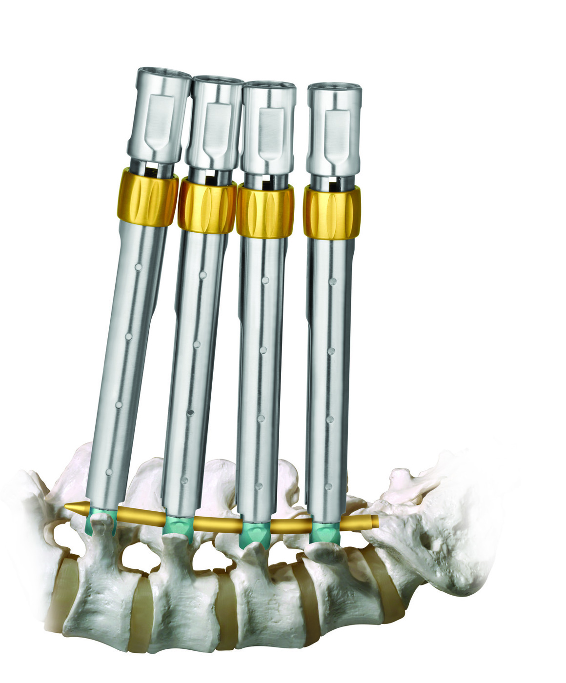 REVOLVE® Minimally Invasive Pedicle Screw