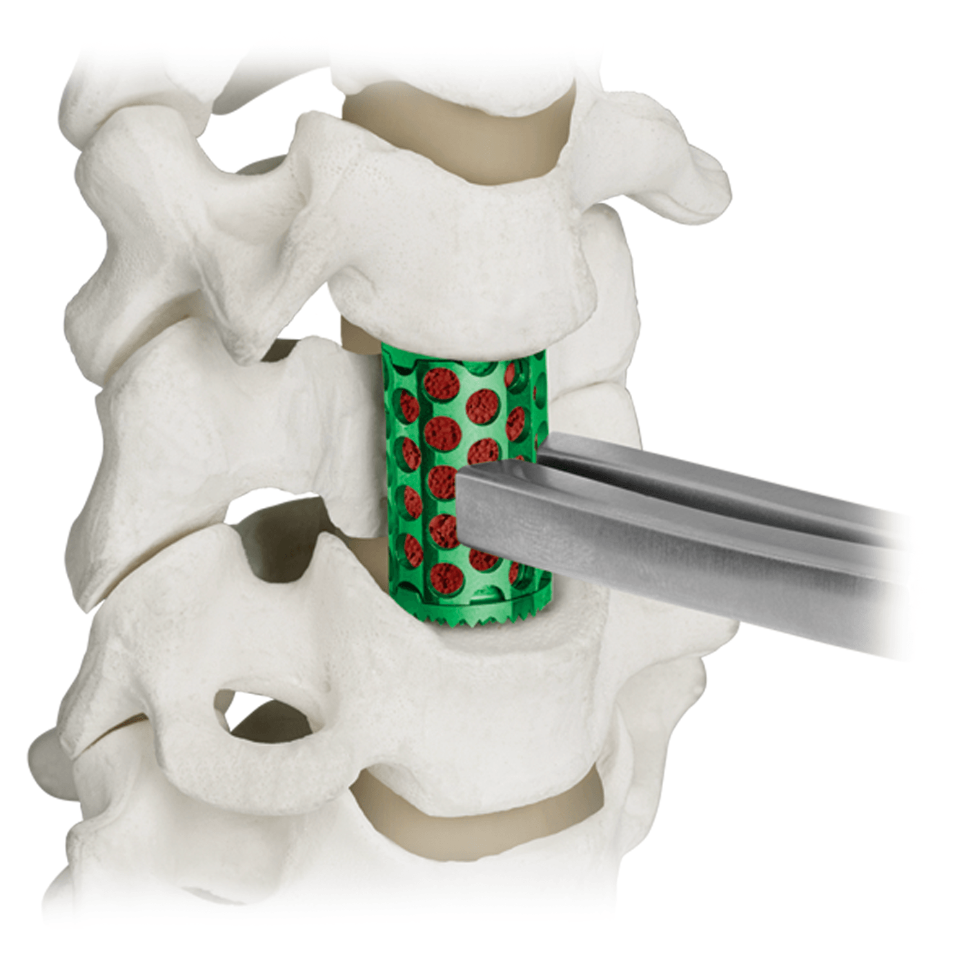 COLOSSEUM™ titanium mesh vertebral body replacement spacer
