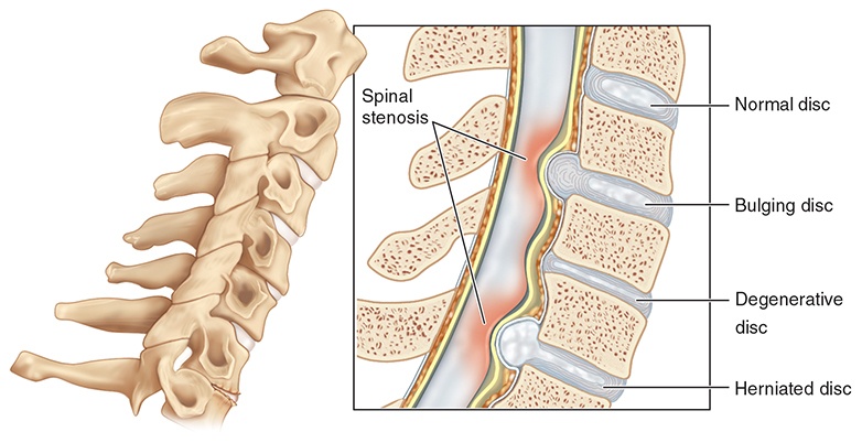 Stenosis