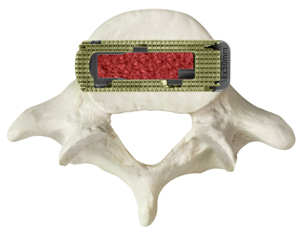 Lateral Lumbar Interbody Fusion Surgery Globus Medical