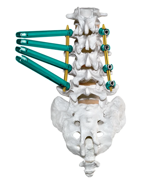 CREO MIS® Stabilization System