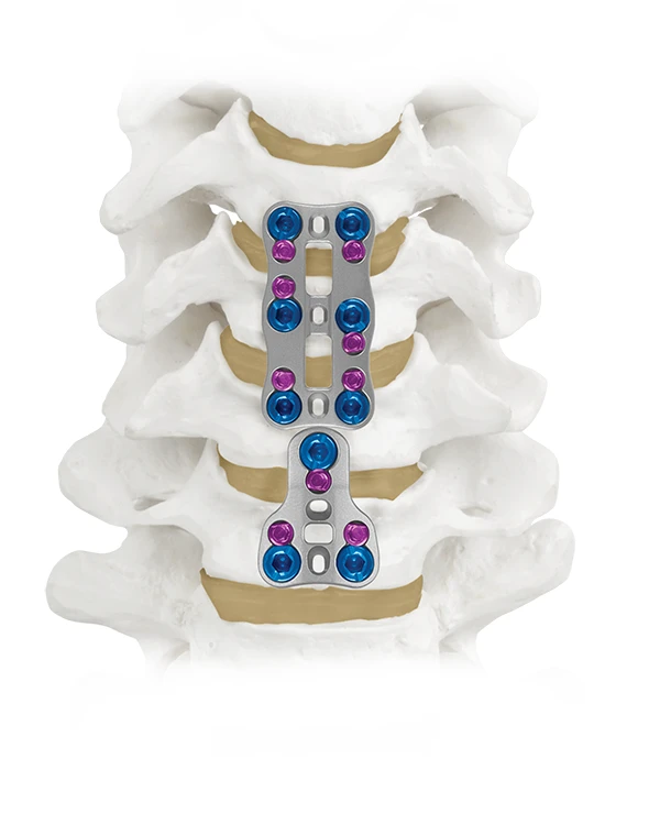 XTEND® Anterior Cervical Plate System