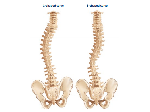 scoliosis-c-s-curve-spine