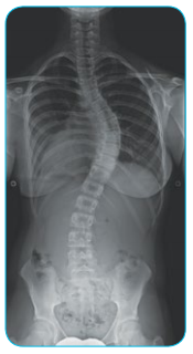 scoliosis-xray-ap