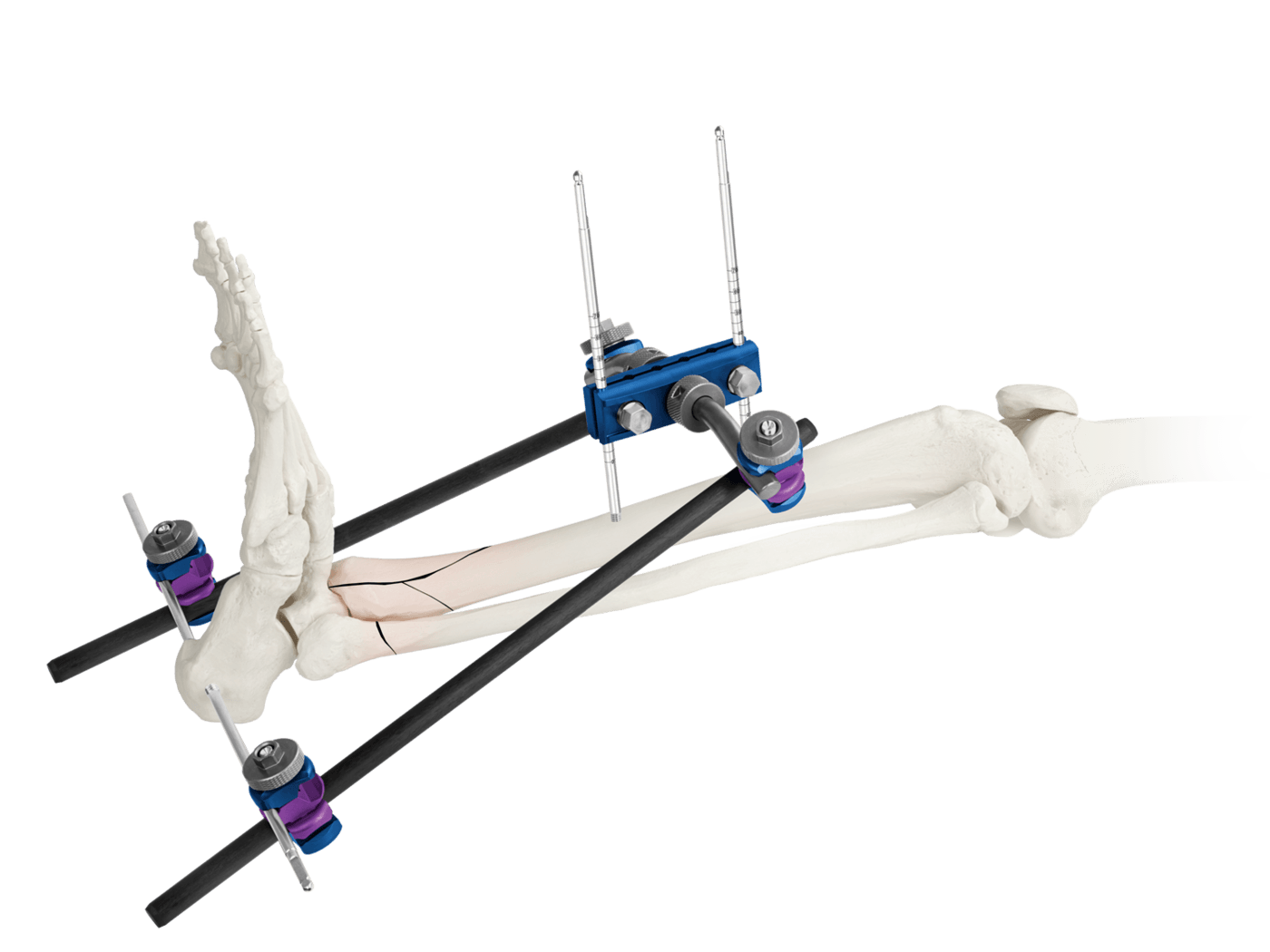 ARBOR® External Fixation