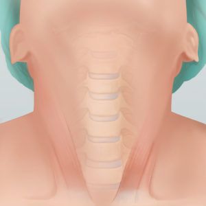 Anterior Cervical Fusion