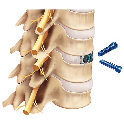 ACDF integrated plate spacer with screws