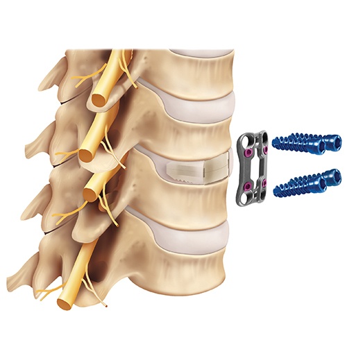 ACDF spacer with cervical plate and screws