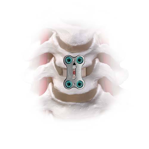 Anterior cervical fusion with plate and screws