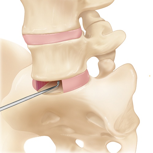 Lumbar Disc Removal