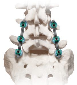 Posterior Thoracolumbar