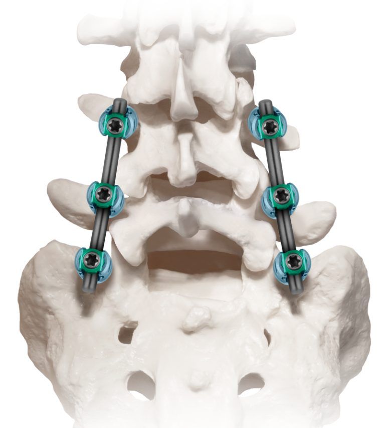 Lateral Lumbar Interbody Fusion Surgery Globus Medical