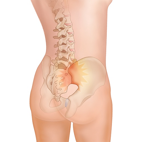 Sacroiliac Joint back pain
